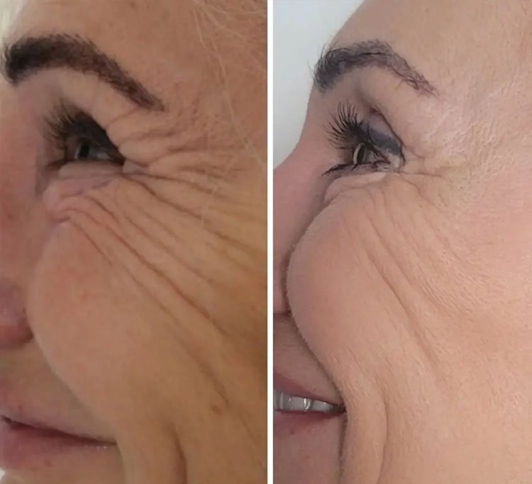 Microneedling elimina cicatricile