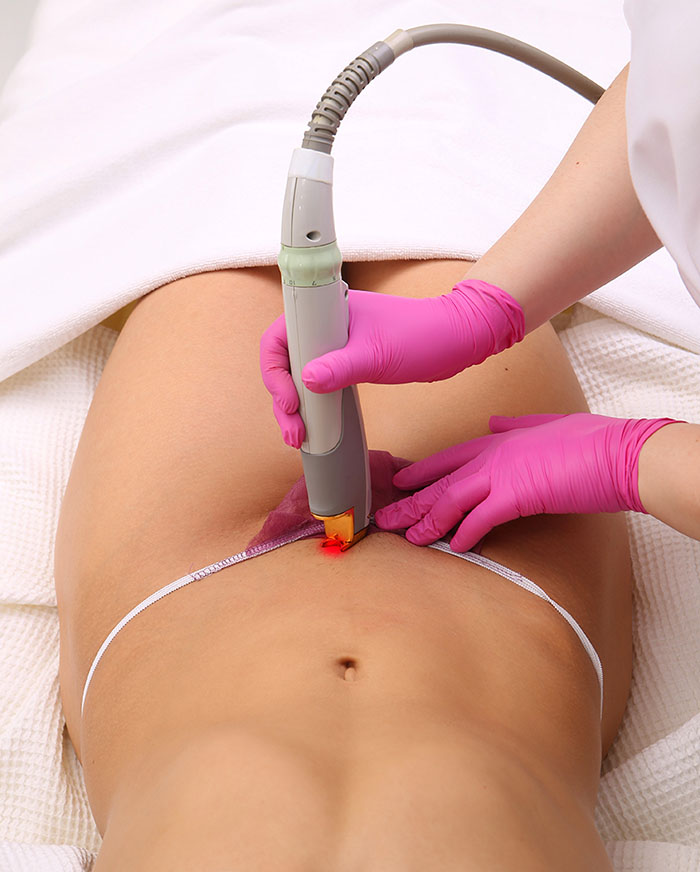 diferenta tehnica intre epilarea laser si IPL