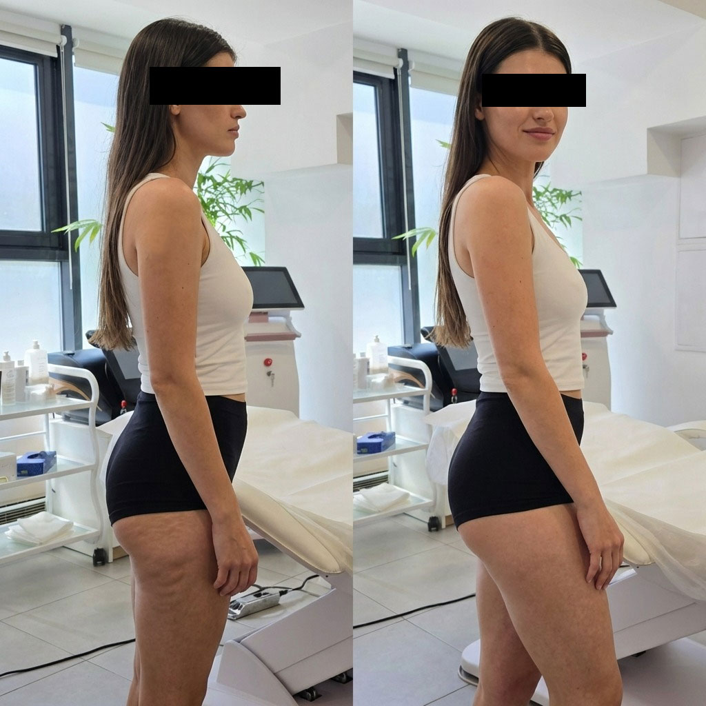 Eliminare celulită cu T-Shape 2.0 — rezultate