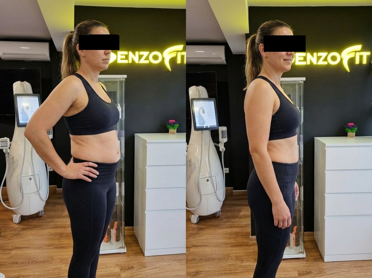 Slăbire abdomen cu T-Shape 2.0 — rezultate