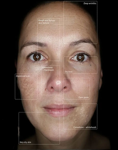 Rezultat analiză facială — identificarea tipului de ten și a zonelor cu pori deschiși