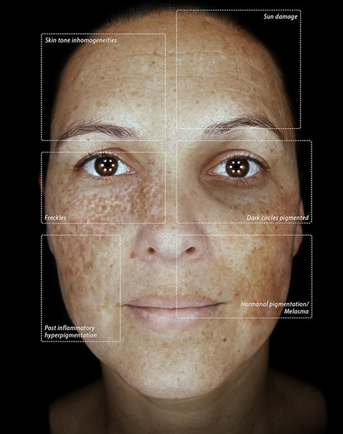 Rezultat analiză facială — identificare melasme și pete pigmentare în straturile profunde ale pielii