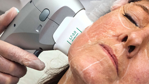 Tratament HIFU pentru redefinirea conturului facial și a liniei mandibulare la SenzoFit Iași