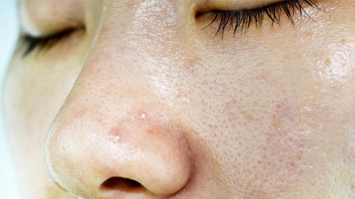 Curățare facială în profunzime prin hidradermabraziune — extracția impurităților din pori