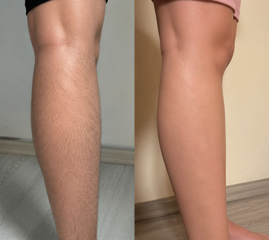 Epilare definitiva cu laser before and after - rezultat 14 — SenzoFit Iași