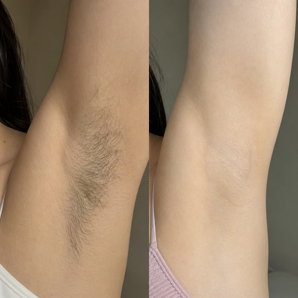 Epilare definitiva cu laser before and after - rezultat 17 — SenzoFit Iași