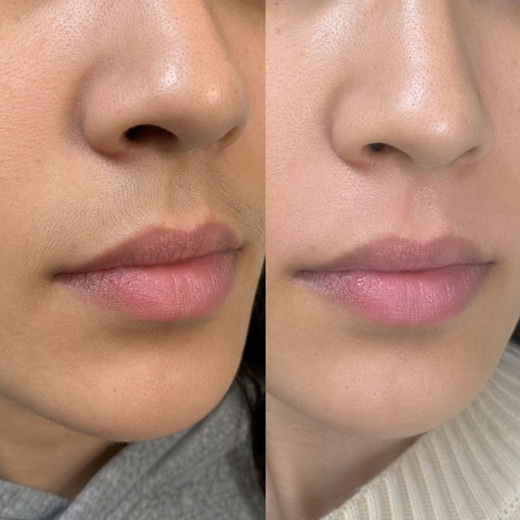 Epilare definitiva cu laser before and after - rezultat 20 — SenzoFit Iași