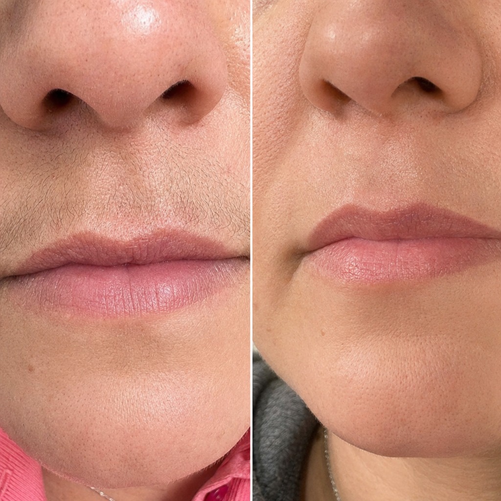 Epilare definitiva cu laser before and after - rezultat 22 — SenzoFit Iași