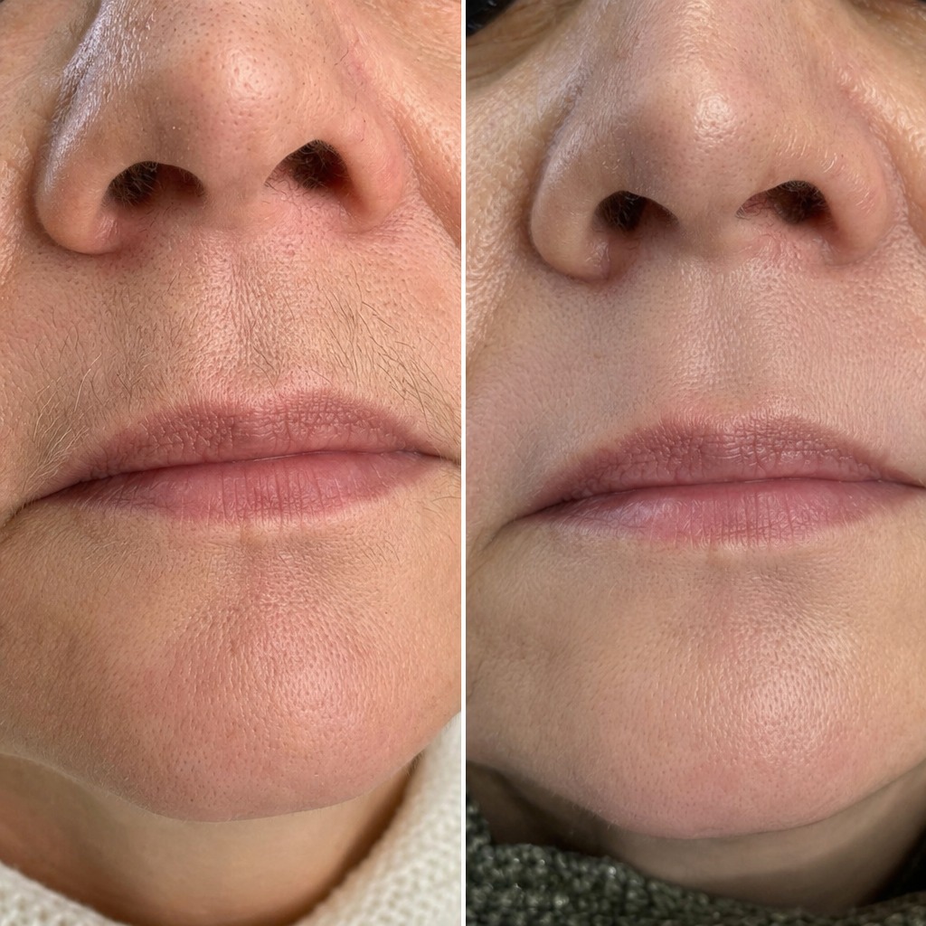 Epilare definitiva cu laser before and after - rezultat 23 — SenzoFit Iași