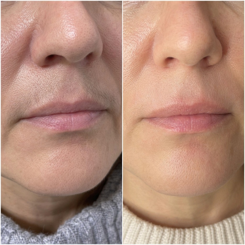 Epilare definitiva cu laser before and after - rezultat 24 — SenzoFit Iași