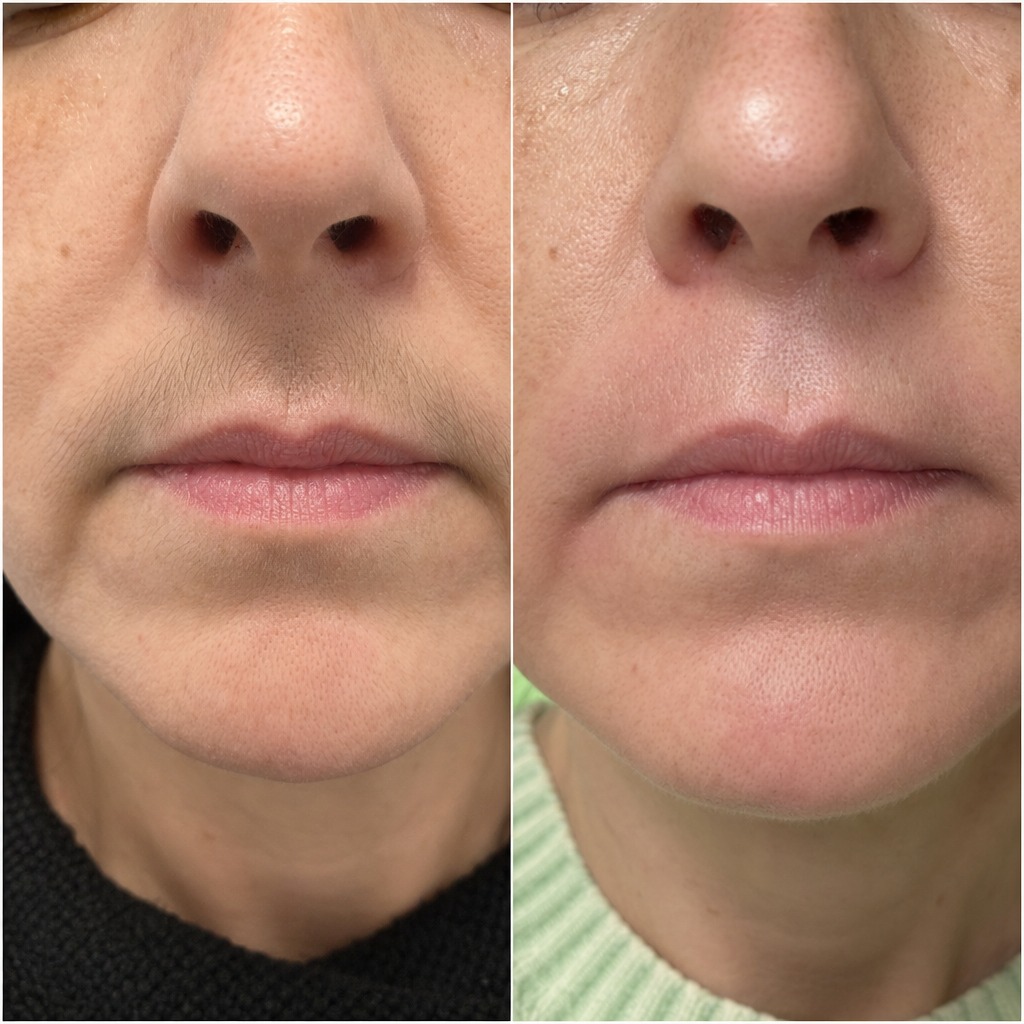 Epilare definitiva cu laser before and after - rezultat 25 — SenzoFit Iași