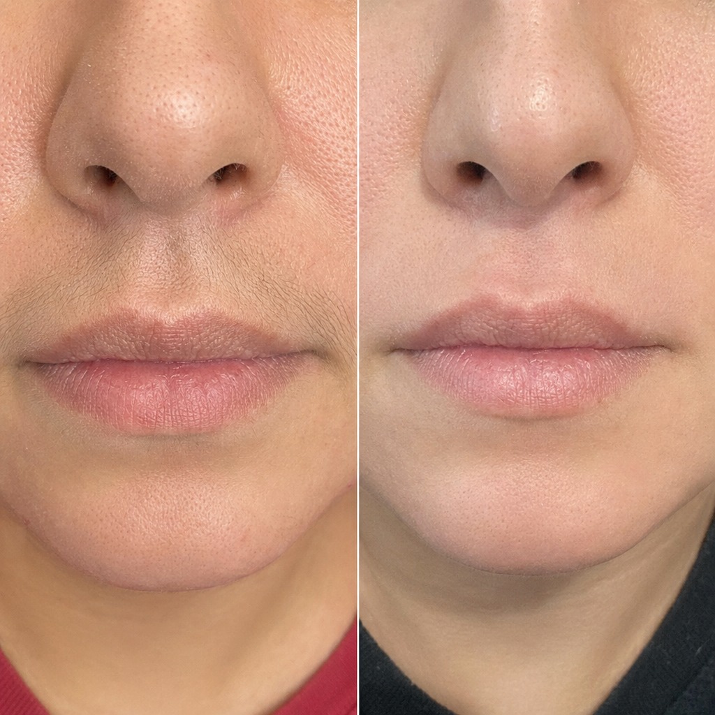 Epilare definitiva cu laser before and after - rezultat 26 — SenzoFit Iași