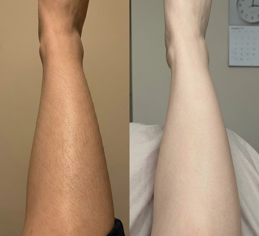 Epilare definitiva cu laser before and after - rezultat 37 — SenzoFit Iași
