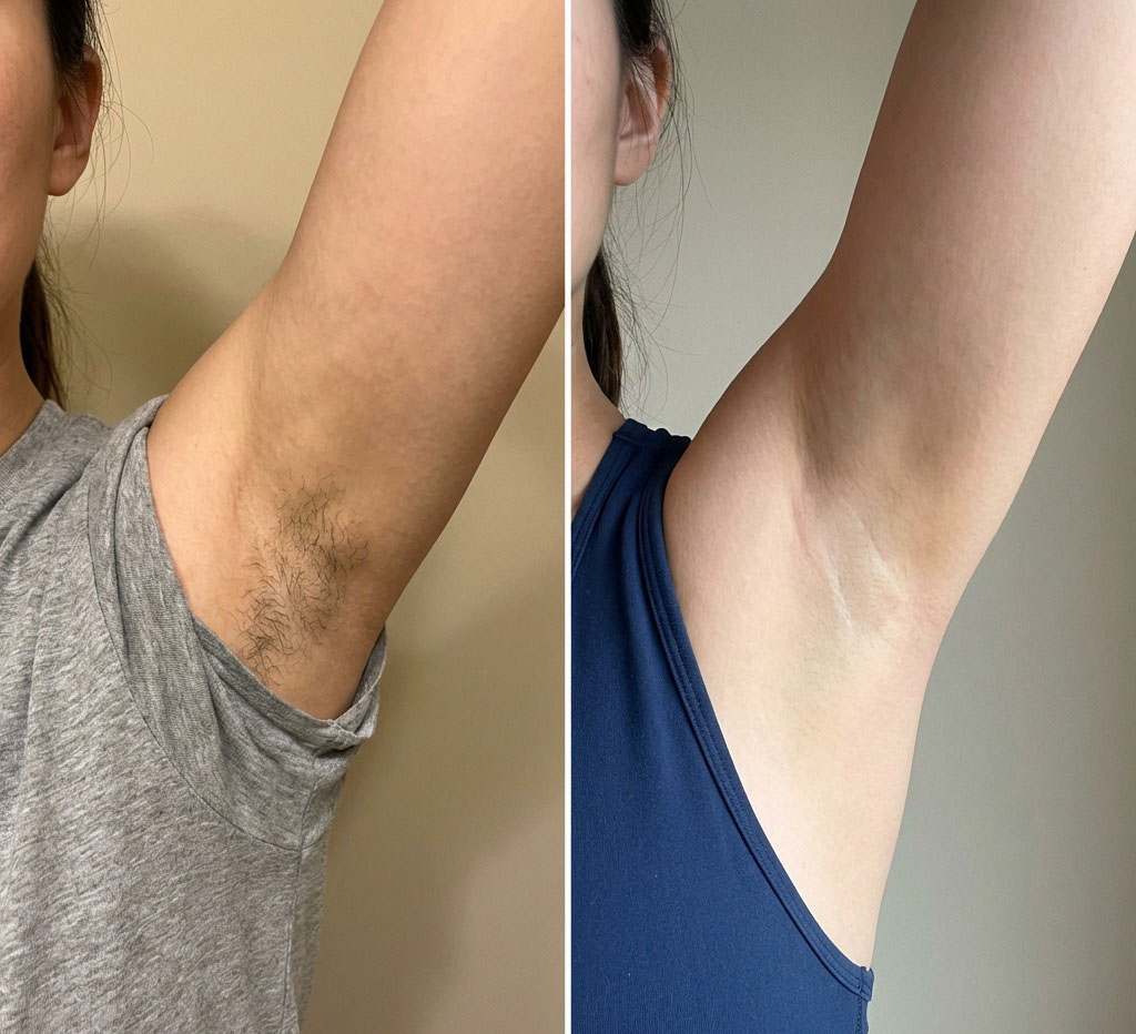 Epilare definitiva cu laser before and after - rezultat 40 — SenzoFit Iași
