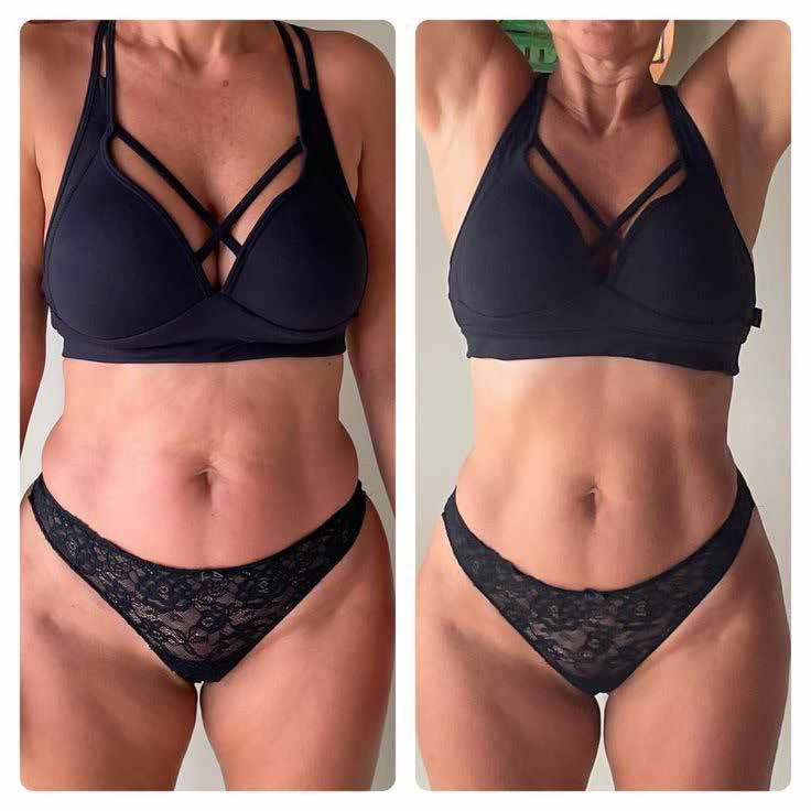Conturarea abdomenului și a taliei cu Jordi Shape — zona tratată înainte și după