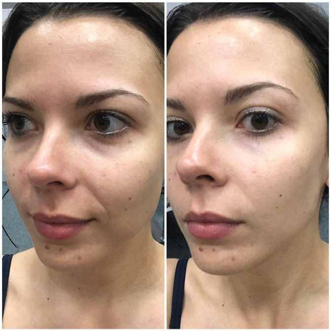 Lifting facial fără injecții — conturul mandibulei înainte și după