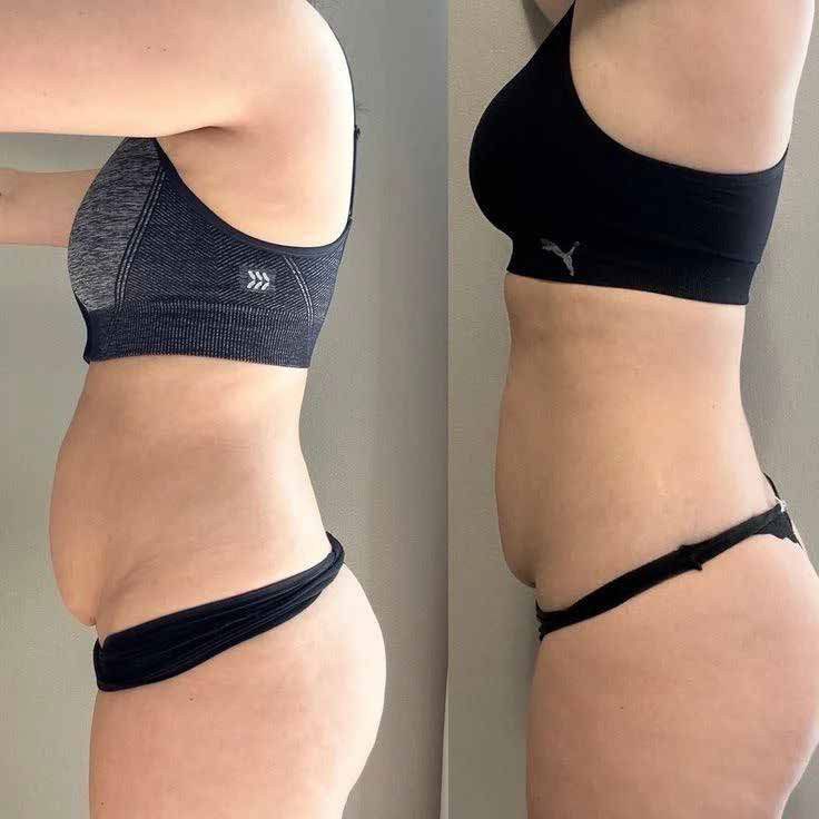 Profil abdomen înainte și după tratamentul de conturare