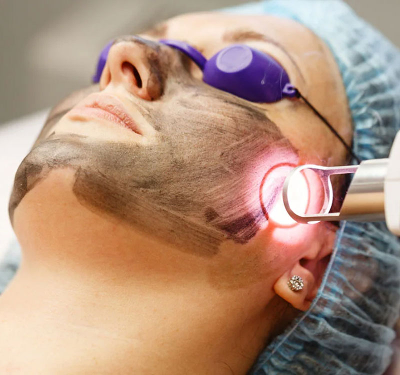 Aplicare loțiune carbon pe față