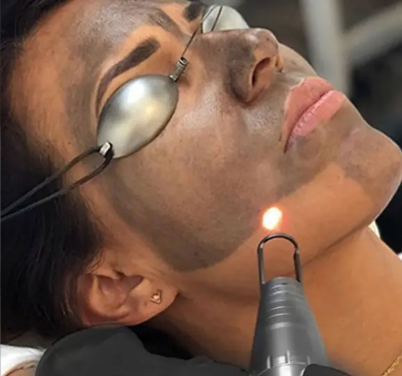 Acțiunea PICO Laser pe carbon