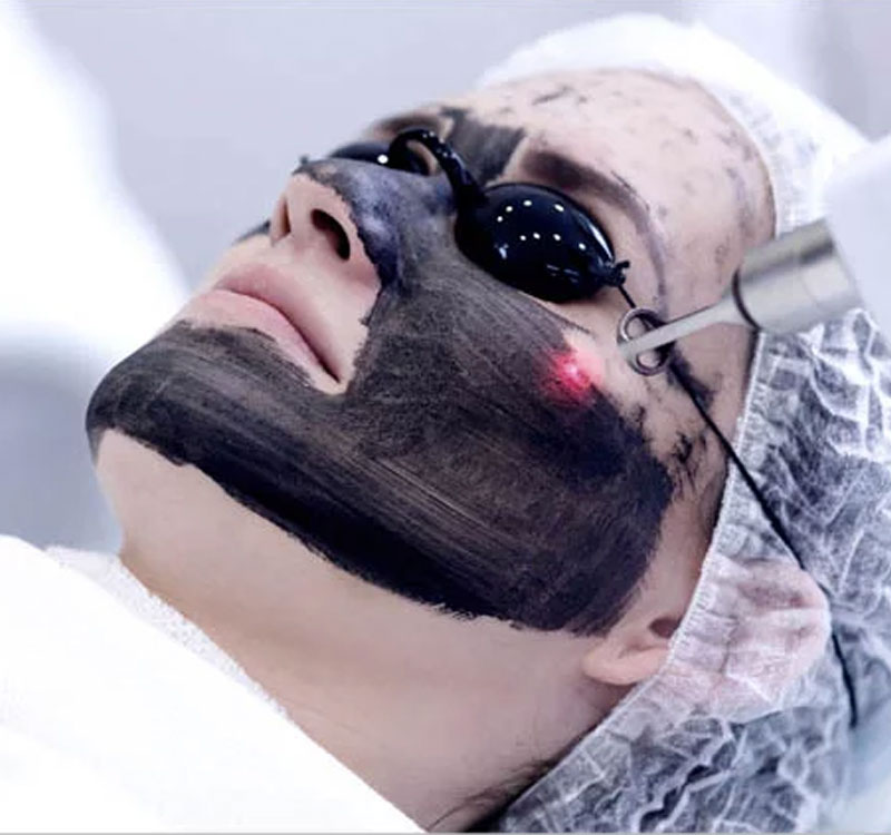 Rezultat piele luminoasă după Carbon Peel