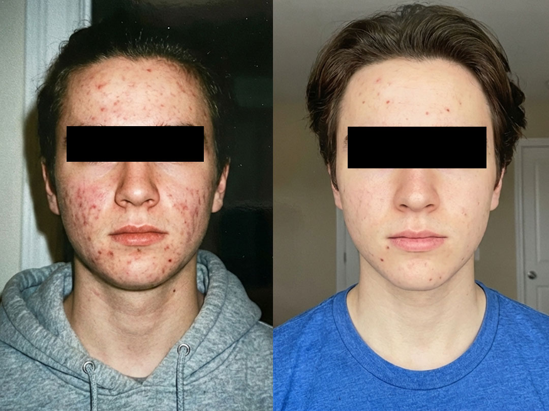 Rezultate Dr. Platon plasmă rece — înainte și după 3