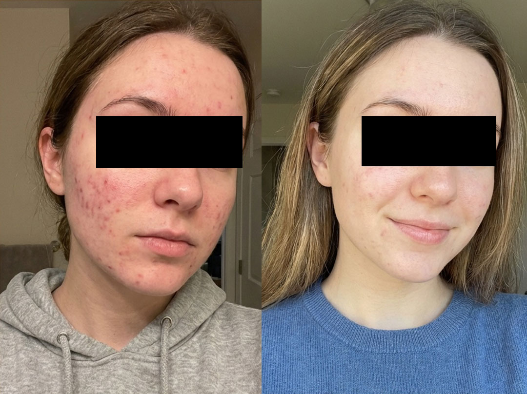 Rezultate Dr. Platon plasmă rece — înainte și după 3