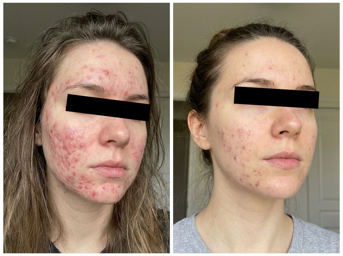 Rezultate Dr. Platon plasmă rece — înainte și după 3