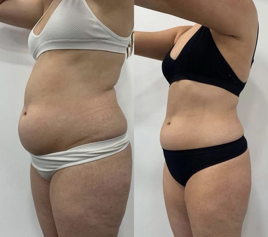 Slăbire cu laser verde – coapse