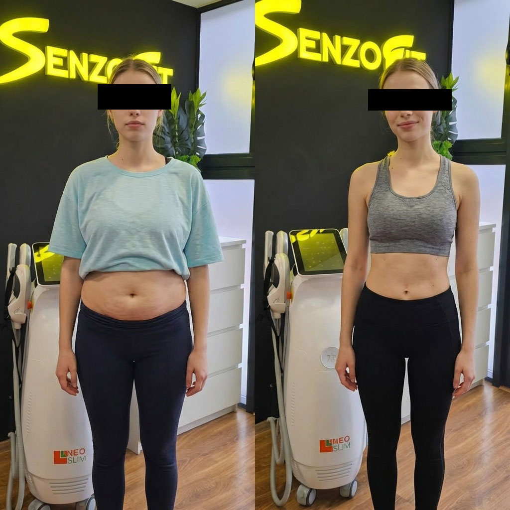 Rezultate InWave — înainte și după tratament remodelare corporală 2