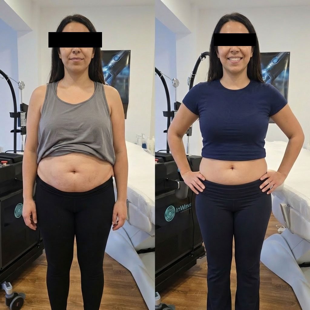 Rezultate InWave — înainte și după tratament remodelare corporală 3