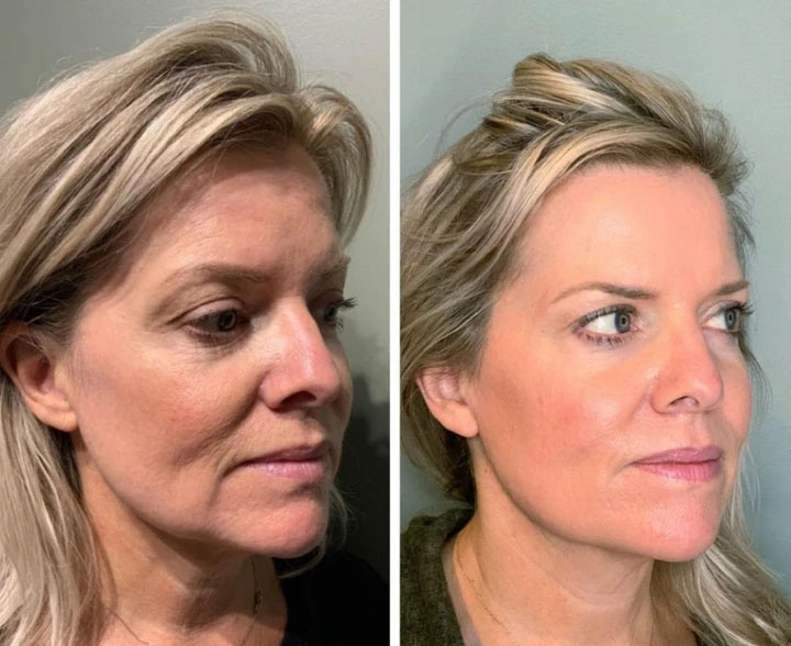 MicroRF — reducerea ridurilor și liniilor de expresie