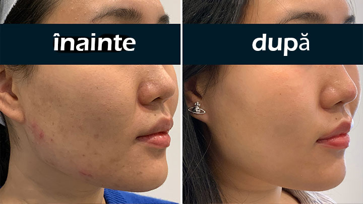 MicroRF — estomparea cicatricilor post-acnee