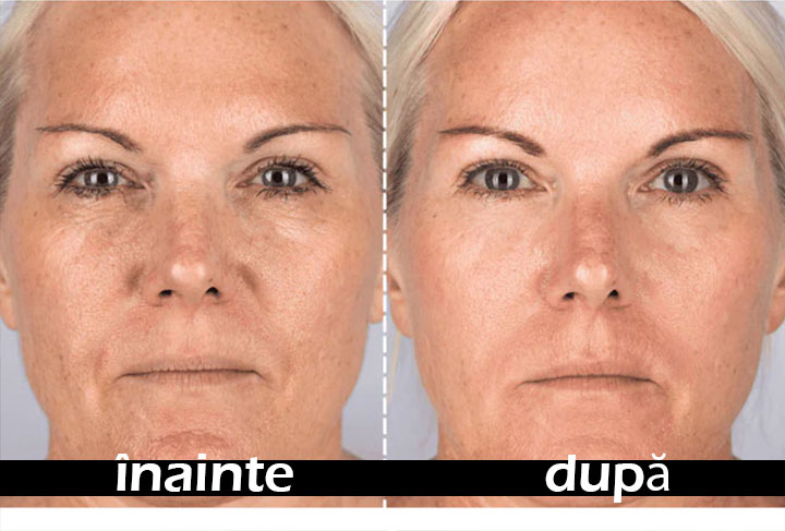 MicroRF — reducerea porilor dilatați