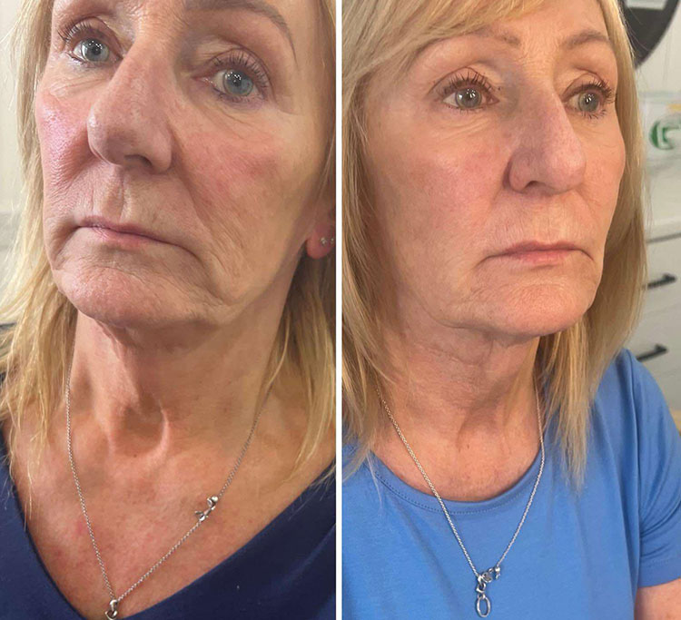 Rezultate MicroRF — rejuvenare facială