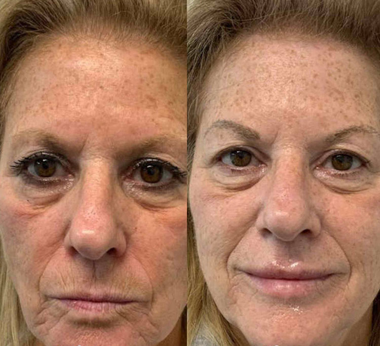 Rezultate MicroRF — lifting și tightening